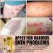 Inalsion Revitaskin Eczema Cure Cream - Eczema & Psoriasis Treatment Relief for Adults (3pcs) - Buy Online on GoSupps.com