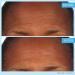 SKINN Dermappeal Microdermabrasion Treatment 2oz - Exfoliating Facial Scrub for Smoother, Brighter, and Flawless Skin - Buy Online on GoSupps.com