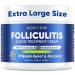 Folliculitis & Acne Treatment Cream Salicylic Acid & Herbal Extracts for Scalp Face Body & Back Soothes Irritated Skin Redness & Itch Relief 100g (Pack of 1) 3.4 Fl Oz (Pack of 1)