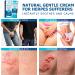 Roycederm Herpes Relief Cream - 60g | Gentle Treatment for Sensitive Skin - Buy Online on GoSupps.com