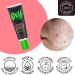 Oxy Acne Vanishing Treatment 0.10-Inches - Buy Online on GoSupps.com