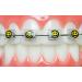 Braces Wax Alternative Bracket Cover Bumper Orthodontic Braces Accessories Snapcaps Smiley Face 10 Ct.
