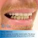Instant Smile Complete Adult Makeover Kit - Fix Your Smile at Home in Minutes! Includes Bright White Upper & Natural Shade Lower - Buy Online on GoSupps.com