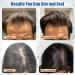 Yuaben Minoxidil Foam for Men & Women - 5% Biotin Infused Extra Strength Hair Regrowth Treatment - Combat Hair Loss - Buy Online on GoSupps.com