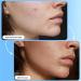 Patch Perfect Spot Patches (102 Pimple Patches) - Hydrocolloid Acne Treatment Dots - Vegan & Cruelty-Free - 2 Sizes - Buy Online on GoSupps.com