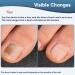 Toenail Fungus Light Device - Effective Treatment for Damaged Discolored Nails | Multi-Nail Onychomycosis Solution (Black - Buy Online on GoSupps.com