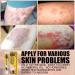 KnjoFly Revitaskin Chinese Herbal Eczema Psoriasis Relief Cream for Adults - Set of 3 - Buy Online on GoSupps.com