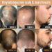 5% Minoxidil Foam for Men - Hair Growth Treatment with Biotin, Caffeine, and Niacinamide - 1 Month Supply - Stronger, Thicker Hair - 2 Fl Oz - Buy Online on GoSupps.com