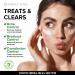 Acne Medication Face Cream - Fast Acting USA-Made Treatment for Stubborn Pimples, Blackheads, Whiteheads - Soothing Moisturizer for Acne Relief & Scar Prevention - 2oz - Buy Online on GoSupps.com