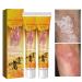 EasPowest Youth Bee New Zealand Professional Bee Venom Psoriasis Treatment Cream, Soothing Moisturizing Psoriasis Cream (2PCS)