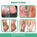 Tea Tree Oil Foot Cream for Dry Cracked Skin - Heel and Callus Treatment, Antifungal Formula for Athlete's Foot, Jock Itch, Eczema - Moisturizing Foot Treatment - Buy Online on GoSupps.com