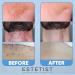 ESTETIST Razor Bump Stopper Solution with Salicylic Acid & Glycolic Acid - Ingrown Hair Treatment for Face, Neck, Bikini, Legs, Underarms - After Shave Serum for Men & Women - Buy Online on GoSupps.com