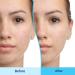 Differin Acne Treatment Gel 45g | Effective Acne Solution & Clear Skin - Buy Online on GoSupps.com