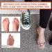 6-Piece Double Toe Straightener & Hammer Toe Splint Set - Relieve Foot Pain, Claw & Overlapping Toes - Beige - Buy Online on GoSupps.com