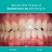 Opalescence Go - Prefilled Teeth Whitening Trays - 15% Hydrogen Peroxide - Mint - Buy Online on GoSupps.com