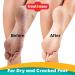 2pk Moisturising Foot Cream for Cracked Heels and Dry Skin | 200g | Dry Foot Cream for Very Dry Feet & Cracked Heel Repair Cream | Heel Balm for Cracked Heel Cream Foot Balm Feet Cream + SOL Sticker - Buy Online on GoSupps.com