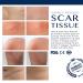 Scar Remover Gel for C-Section Stretch Marks Acne Surgery - 30g (1.05oz) | Effective on Old & New Scars - Buy Online on GoSupps.com