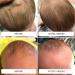 Happy Cappy Medicated Shampoo for Children - Treats Dandruff & Dermatitis - 8 oz (Pack of 4) - Buy Online on GoSupps.com