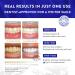 Teeth Whitening Strips - DentaMeld Technology for 3X Whiter Teeth - Sensitive Teeth Kit by UK Dentists - Buy Online on GoSupps.com
