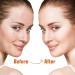 Hydrocolloid Pimple Patches for Acne - Tea Tree Oil Spot Stickers Vegan & Cruelty Free | 72 Count - Buy Online on GoSupps.com