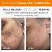 Andalou Naturals Dark Spot Corrector Serum | Brightening Face Treatment with Vitamin C | Reduce Acne Scars & Hyperpigmentation | Even Skin Tone | 1 Oz - Buy Online on GoSupps.com