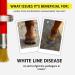Hoof Doctor Oil - White Line | Thrush | Abscesses | Quarter Crack | Seedy Toe | Corns and Sole Bruises - 100% All-Natural Hoof Care Product - Birch Bark Extract Betulin Omega-3 with Vitamins A & D 16 fl.oz - Buy Online on GoSupps.com