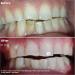 Teeth Whitening Kit - USA Dentist Recommended Professional LED Light & 5ml Gel Syringes - Crystal Clear 35% Carbamide Peroxide - Buy Online on GoSupps.com