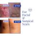 Rejuvaskin Scar Heal Kit - Small to Medium Scar Treatment - Soften, Flatten, and Reduce Scars - Physician Recommended - Buy Online on GoSupps.com