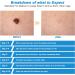 Painless Skin Tag Remover Pen Kit with 40 Bands - Easy Device for 2mm-8mm Skin Tags - Buy Online on GoSupps.com
