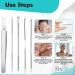 Blackhead Remover Pimple Squeezing Tool Set 5 Pieces Stainless Steel Pimple Remover Comedone Squeezer Blackhead Remover Pimple Popper Milia Remover Acne Blackhead Extractor Pore Cleaner Tweezers - Buy Online on GoSupps.com