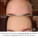 Dermaroller Faces of Fey - 192 Real Needles Microneedling Roller 0.25mm for Face - Professional At-Home Skin Tightening & Modeling - Buy Online on GoSupps.com