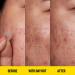 PEACE OUT Acne Day Dot | 6-Hour Fast-Acting Pimple Patch with Salicylic Acid | Clear Breakouts & Blemishes in Hours (20 Dots) - Buy Online on GoSupps.com