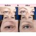Venicce Love Eyelid Tape - 1 200 Loophole Tapes for Instant Eyelid Lift | Skin-Coloring Adhesive Stripes | Non-Surgical Solution for Beautiful Eyes - Buy Online on GoSupps.com