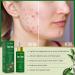Organic Tea Tree Serum with Vitamin C - Clear Acne Scars Dark Spots & Blemishes | 2 Fl Oz for Youthful Glowing Skin - Buy Online on GoSupps.com