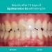 Opalescence Go 10% Hydrogen Peroxide Teeth Whitening Trays - Mint Flavor - Buy Online on GoSupps.com