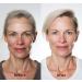 Forehead Wrinkle Patch Set | 4 Reusable Silicone Patches for Eyes & Smile Lines - Boost Skin Texture & Radiance - Buy Online on GoSupps.com