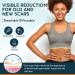 NUVADERMIS Silicone Scar Tape - 120 x 1.5 Roll - Extra Long for Surgical Scars - Medical Grade Reusable Silicone - Ideal for C-Section, Tummy Tuck, Keloid Scars - Buy Online on GoSupps.com