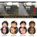 BEEOS 13x6 SKINILIKE Real HD Lace Frontal Only Small Knot Pre-plucked Vivid Hairline Straight Human Hair Frontal 18 Inch 13x6 HD Lace Fronal 18 Inch - Buy Online on GoSupps.com