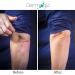 Keratosis Pilaris Treatment - 12% Lactic Acid Lotion for Bumps Body Acne & Rough Skin Relief | Moisturizing Repair Cream - Buy Online on GoSupps.com