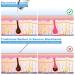 EUASOO USB Rechargeable Blackhead Remover Kit for Women & Men - Electric Pore Vacuum Tool with 10 Filters & 5 Rubber Rings - Buy Online on GoSupps.com