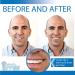 Instant Smile Temporary Tooth Kit - Pro-Series: Transform Your Smile Instantly - Buy Online on GoSupps.com