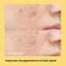 AVARELLE Dark Spot Patches - Acne Treatment (9 CT) | Face & Body Pimple Patches with Vitamin C Niacinamide Tranexamic Acid & Kojic Acid for Post-Blemish Care - Buy Online on GoSupps.com