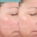 PMD Personal Microderm Elite Pro - At-Home Microdermabrasion Machine for Face and Body - Exfoliating Crystals and Vacuum Suction for Radiant Skin - Three Speed Options - Buy Online on GoSupps.com
