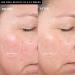 Personal Microderm Elite Pro Black - Best At-Home Microdermabrasion Device for Flawless Skin | International Shipping Available - Buy Online on GoSupps.com