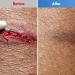 Hydrocolloid Wound Dressings - 10cm x 10cm 10 Pcs | Large Waterproof Support for Pressure Ulcers Burns & Quick Healing - Ourmed - Buy Online on GoSupps.com