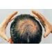 Buy Kami Hair Growth Scalp Therapy - Sterile Microneedling Serum for Dermapen & Dermaroller | Stop Hair Loss & Stimulate Growth - 10 Active Ingredient Ampoules (10 ml) - Buy Online on GoSupps.com