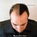 Refill kit Hair Fiber By Samson XLarge 50 Grams Hide Hair Loss and Hair Transplant Natural Looking Results Made in USA Hair Loss Concealer (Medium Brown) - Buy Online on GoSupps.com