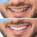 Meawhite Tooth Light Set - Professional Teeth Whitening Kit for Bright White Smile | Peroxide-Free Home Bleaching - Buy Online on GoSupps.com