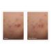 Shop Murad Rapid Relief Acne Spot Treatment - 0.5 oz/ 15 mL Online - Best Price & International Shipping - Buy Online on GoSupps.com