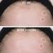 Shop First Aid Beauty FAB Pharma BHA Acne Spot Treatment Gel 2% Salicylic Acid Online - Best Price & International Shipping - Buy Online on GoSupps.com